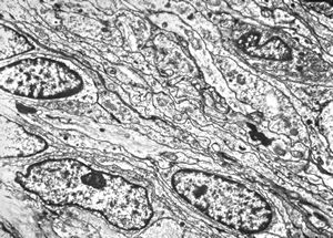M,55y. | meningotheliomatous meningeoma M,55y. | meningotheliomatous meningeoma